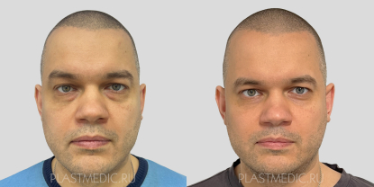 Нижняя трансконъюнктивальная блефаропластика и фототермолиз. Хирург: Раши Т.Р.